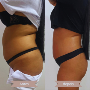 Criolipólise com placas na Clínica JRT estética avançada
