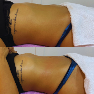 Criolipólise e Radiofrequeência na Clínica JRT estética avançada