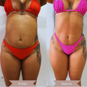 Harmonização corporal - criolipólise