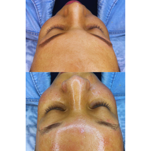 Limpeza de pele na Clínica JRT estética avançada