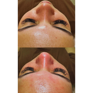 Peeling na Clínica JRT estética avançada